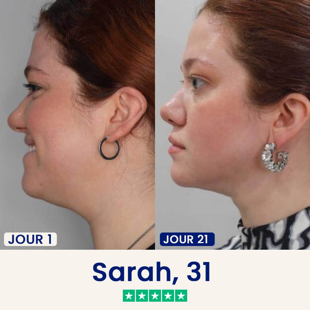 Le Chinology™ Lift (Offre Nouvel An)